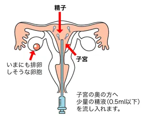 人工授精法(AIH)のイメージ