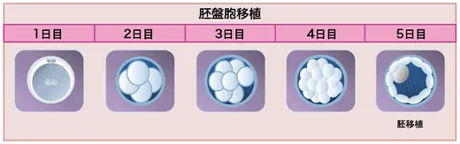 胚盤胞移植